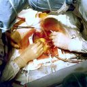 Igor D. Gregorič: Mehanska srčna podpora in transplantacija srca pri napredovanem srčnem popuščanju