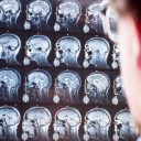 Posledice koronavirusnih obolenj na možganih? Zdravniki zelo zaskrbljeni.