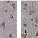 Raziskovalci identificirali spremembo na proteinu, povezanim s frontotemporalno demenco
